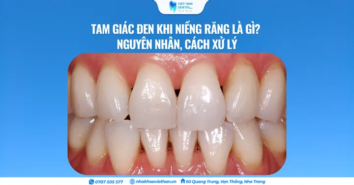 Tam giác đen khi niềng răng là gì? Nguyên nhân, cách xử lý