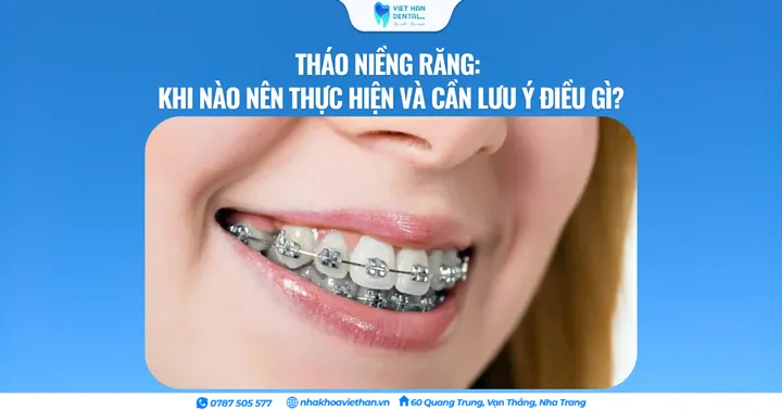 Tháo niềng răng: Khi nào nên thực hiện và cần lưu ý điều gì?