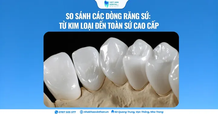 So sánh các dòng răng sứ: Từ kim loại đến toàn sứ cao cấp