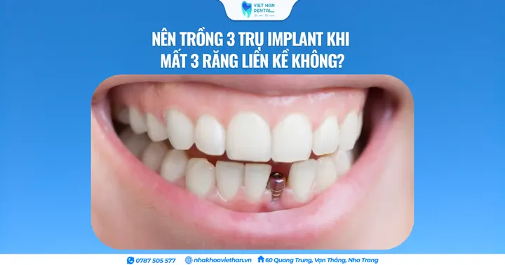 Nên trồng 3 trụ Implant khi mất 3 răng liền kề không?