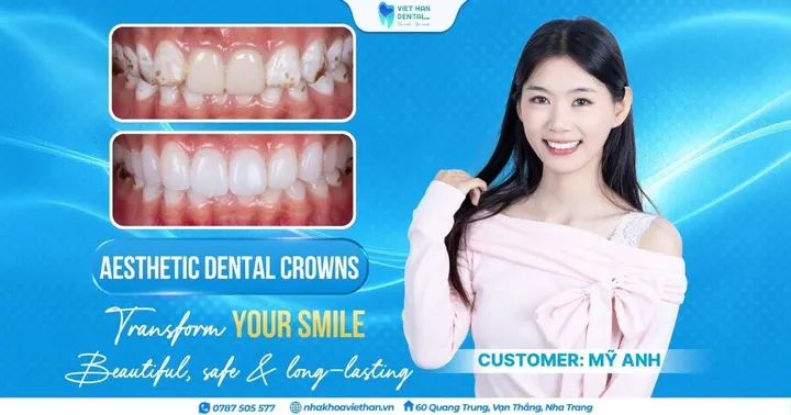 Porcelain Veneers: Mỹ Anh’s Glow-Up Thanks to Her New Smile