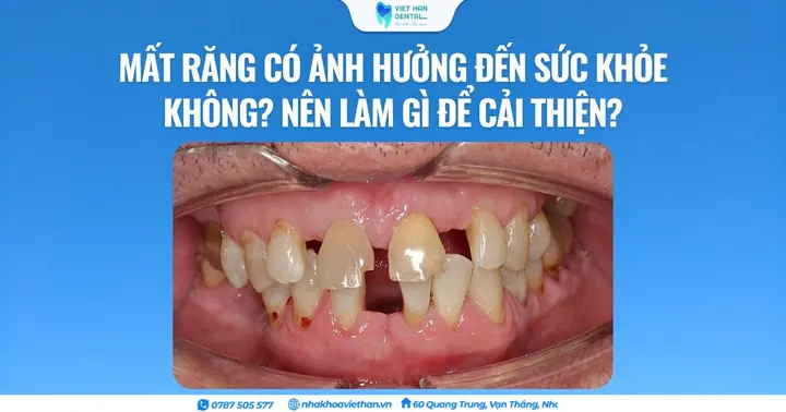 Mất răng có ảnh hưởng đến sức khỏe không? Nên làm gì để cải thiện?