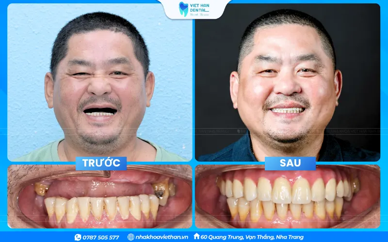 Trồng răng Implant có thể sử dụng đến trọn đời nếu chăm sóc đúng cách