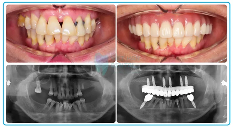 Hình ảnh khách hàng trước và sau khi trồng răng Implant tại Nha khoa Việt Hàn