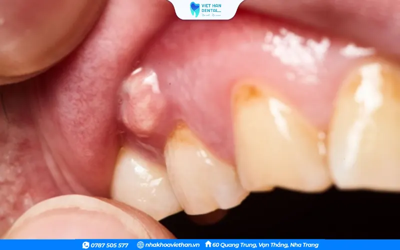 Xuất hiện ủ áp xe