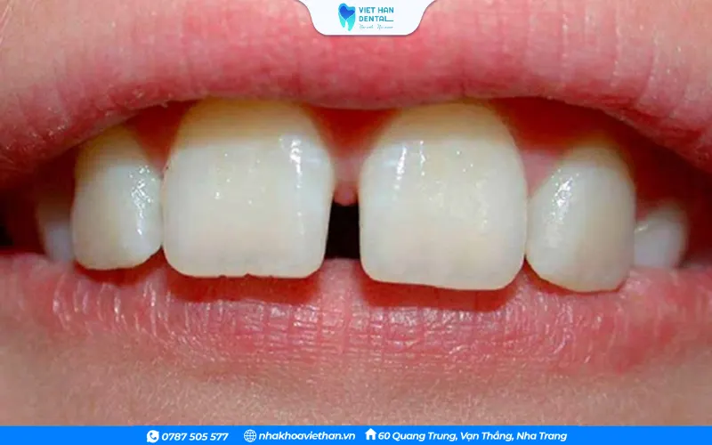 6Thường xuyên ăn nhai các vật cứng cũng sẽ làm răng cửa bị cách xa nhau