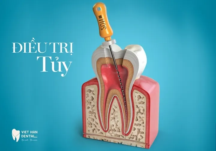 Điều Trị Tủy Răng
