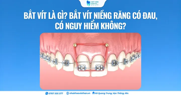 Bắt vít là gì? Bắt vít niềng răng có đau, có nguy hiểm không?