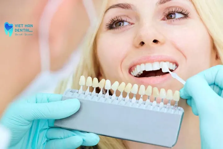 Làm mặt dán sứ Veneer trong bao lâu?