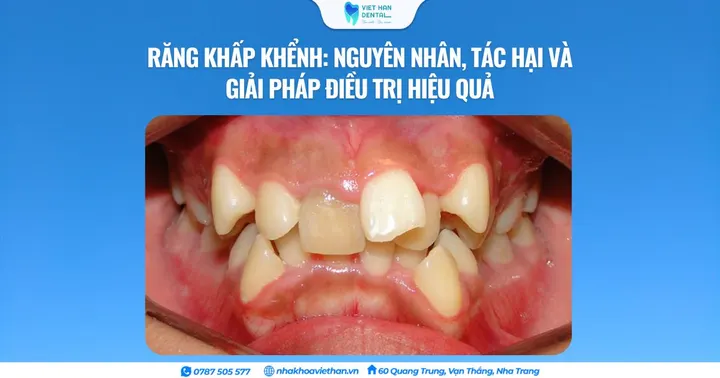 Răng khấp khểnh: Nguyên nhân, tác hại và giải pháp điều trị hiệu quả