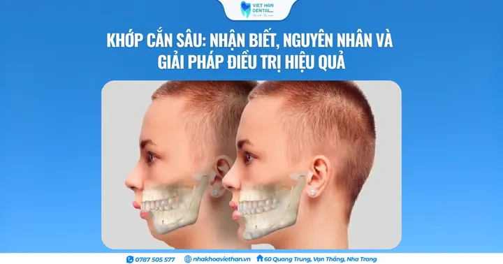 Khớp cắn sâu: Nhận biết, nguyên nhân và giải pháp điều trị hiệu quả