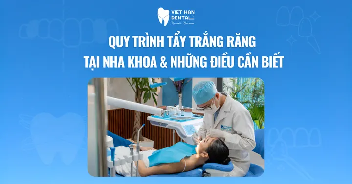 Quy trình tẩy trắng răng tại nha khoa & Những điều cần biết