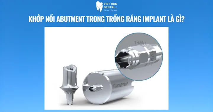Khớp nối Abutment trong trồng răng Implant là gì?