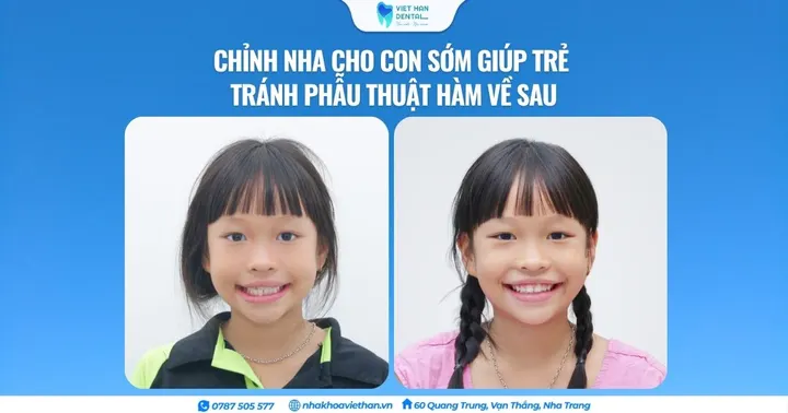 Chỉnh nha cho con sớm giúp trẻ tránh phẫu thuật hàm về sau
