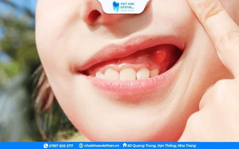 Vùng nướu quanh răng áp xe sưng tấy, có thể đổi màu bất thường