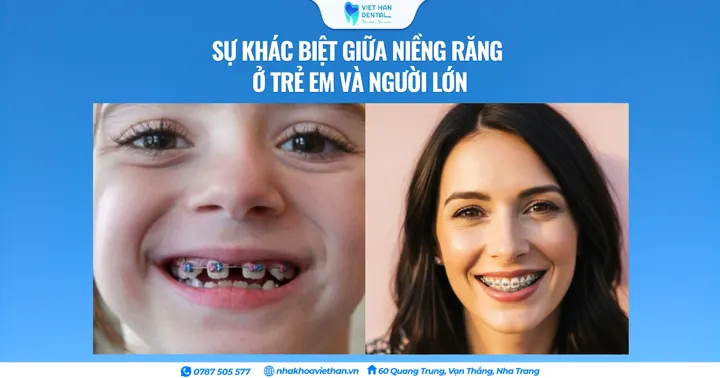 Sự khác biệt giữa niềng răng ở trẻ em và người lớn