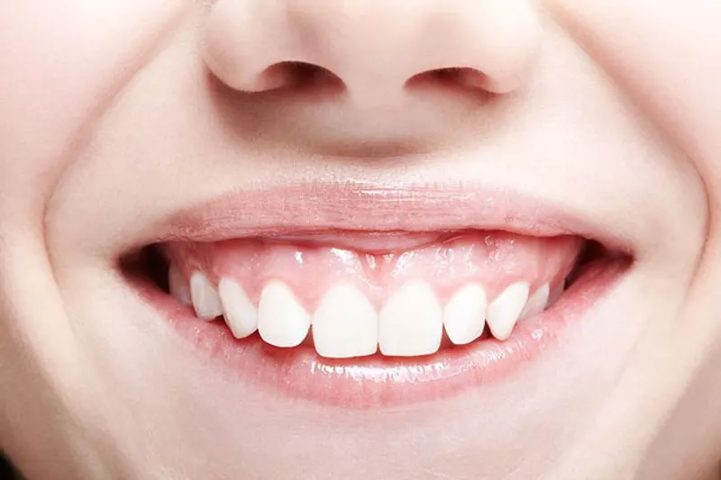 Tình trạng cười lợi