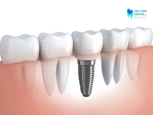 Trồng răng Implant