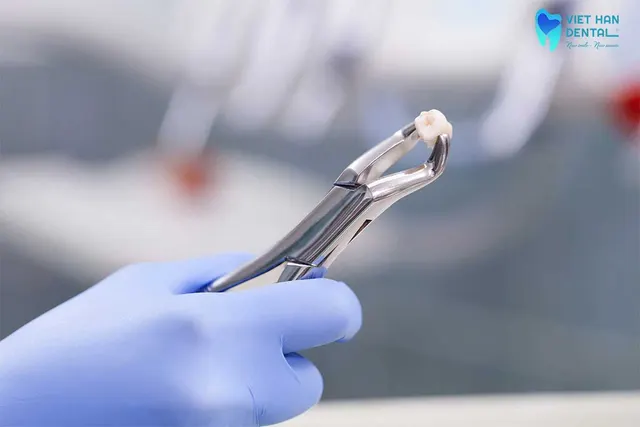 Các trường hợp cần phải nhổ răng khôn 