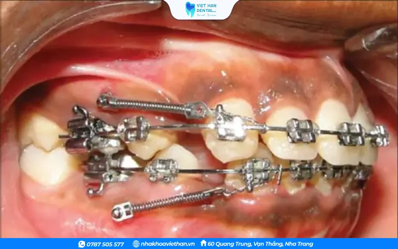 Niềng răng bị đau nhức kéo dài, không có dấu hiệu thuyên giảm nên thăm khám kịp thời