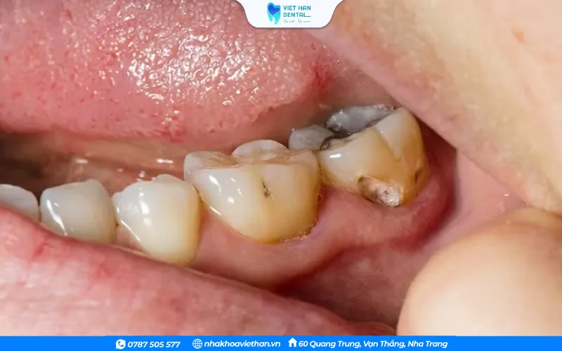 Răng cấm bị sâu 