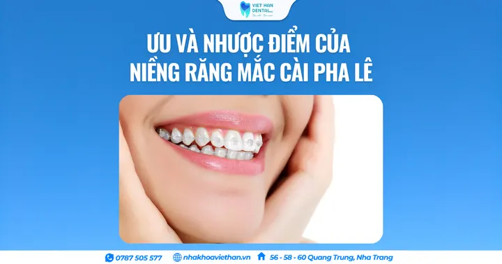 Ưu và nhược điểm của niềng răng mắc cài pha lê
