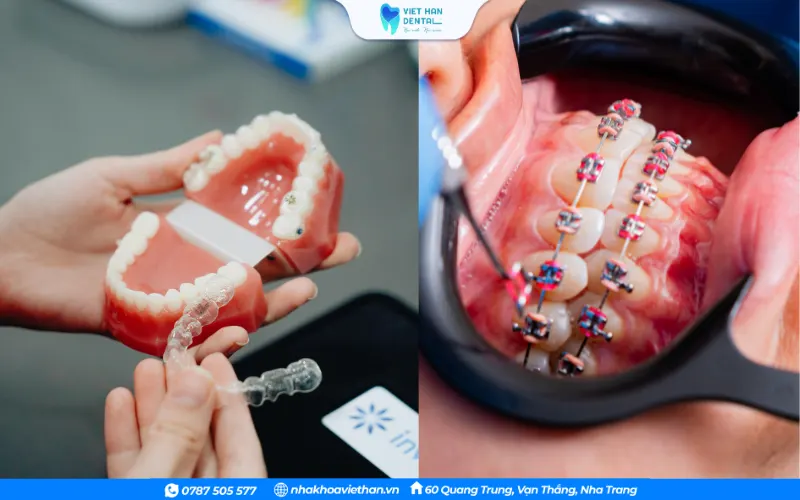 Một ca niềng răng thường kéo dài từ 1,5 -3 năm