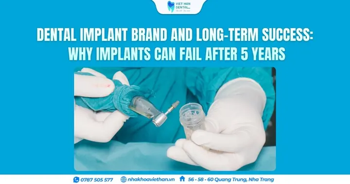 Dental Implant Brand and Long-Term Success: Why Implants Can Fail After 5 Years