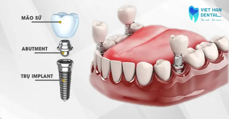 Cấu tạo của một răng Implant 