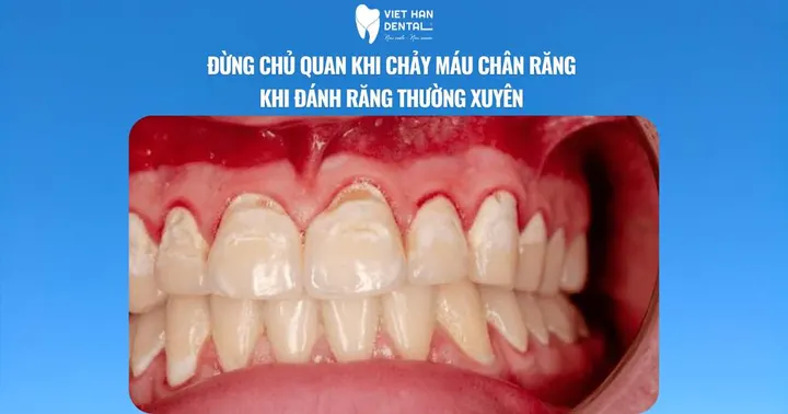 Đừng chủ quan nếu thường xuyên bị chảy máu khi đánh răng