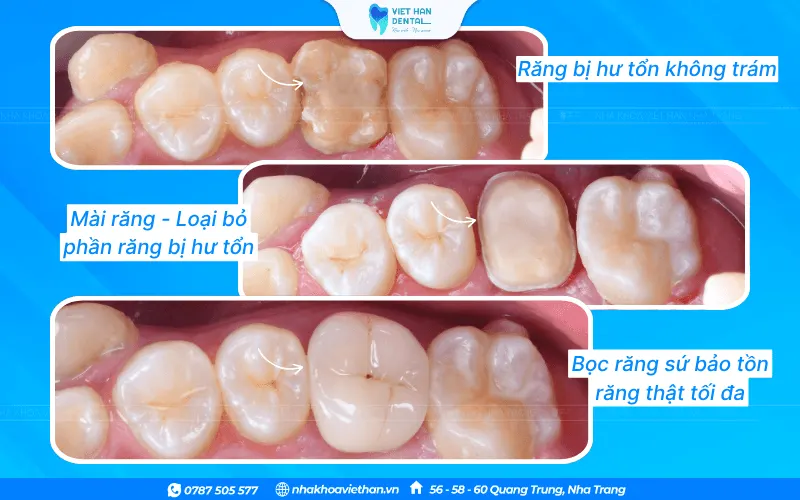 Khách hàng bọc răng sứ tại Nha khoa Việt Hàn 