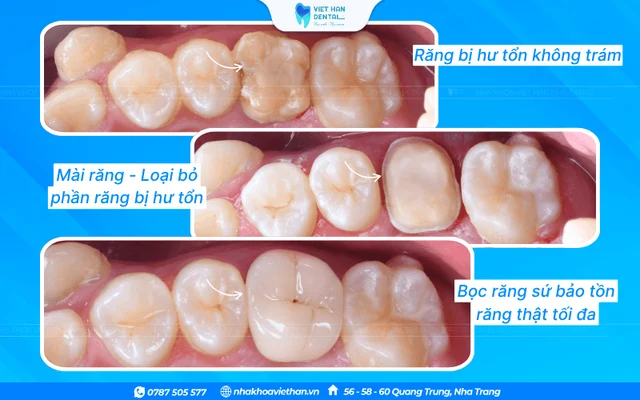 Khách hàng bọc răng sứ tại Nha khoa Việt Hàn của Bác sĩ Khổng Văn Quân