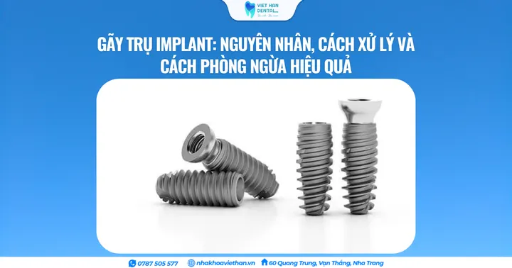 Gãy trụ Implant: Nguyên nhân, cách xử lý và cách phòng ngừa hiệu quả