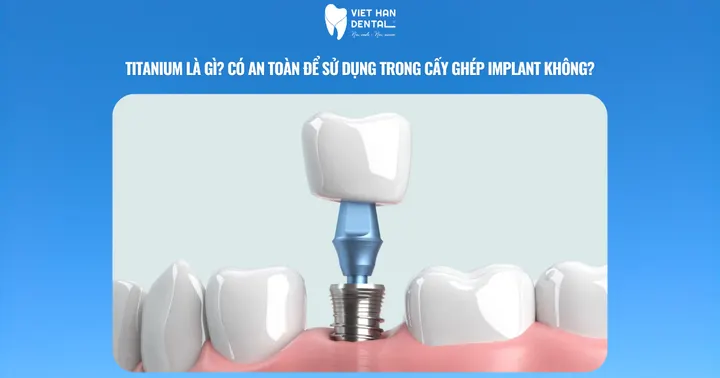 Titanium là gì? Có an toàn để sử dụng trong cấy ghép Implant không?