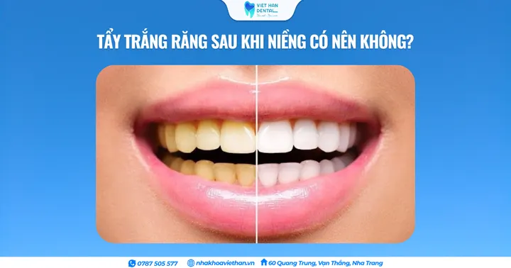 Tẩy trắng răng sau khi niềng có nên không? Bí quyết giữ nụ cười