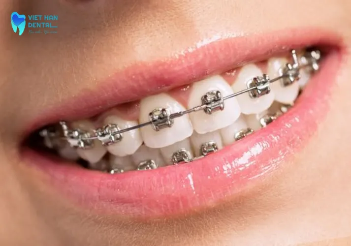 Niềng răng hỗ trợ khớp cắn chuẩn, giúp ăn nhai thoải mái và hiệu quả hơn