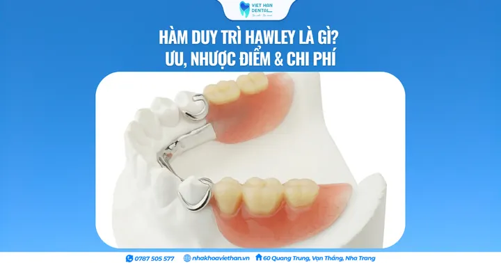 Hàm duy trì Hawley là gì? Ưu, nhược điểm & chi phí