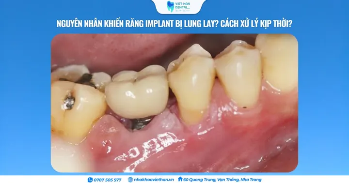 Nguyên nhân khiến răng Implant bị lung lay? Cách xử lý kịp thời?