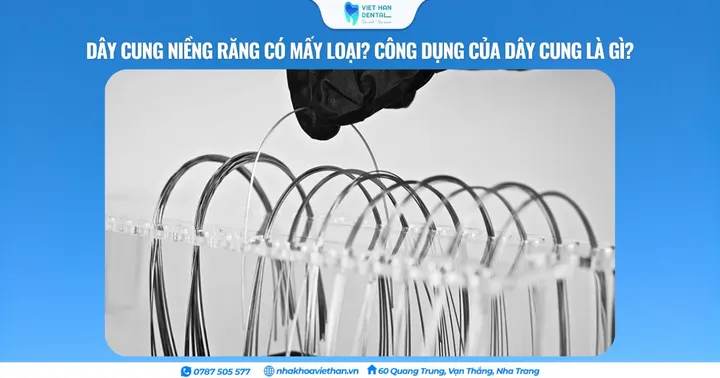 Dây cung niềng răng có mấy loại? Công dụng của dây cung là gì?