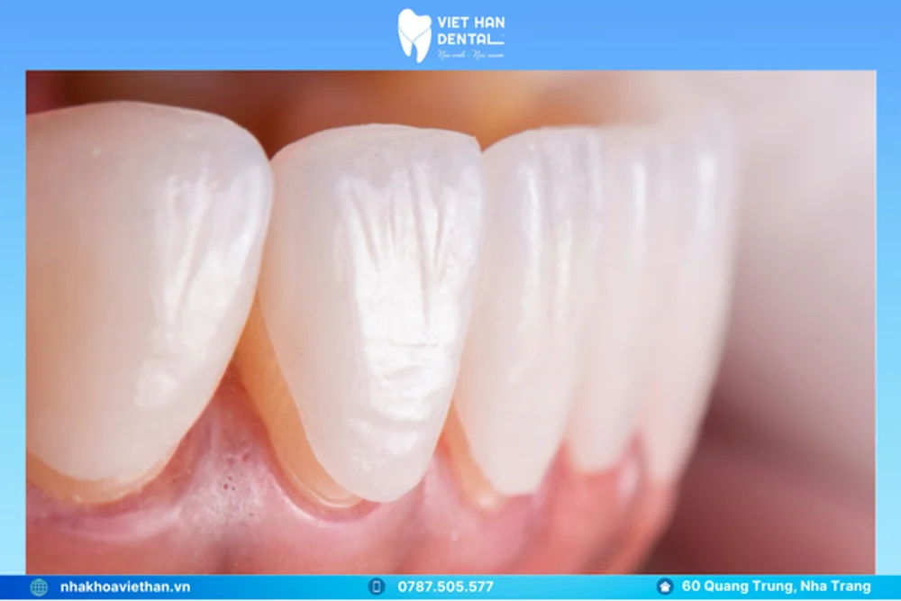 Veneer Lisi 