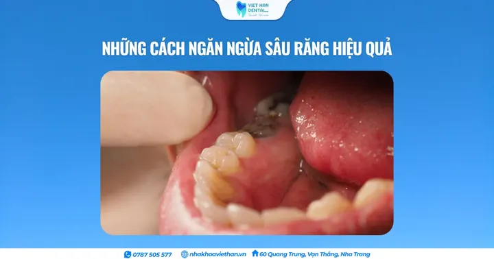 Những cách ngăn ngừa sâu răng hiệu quả
