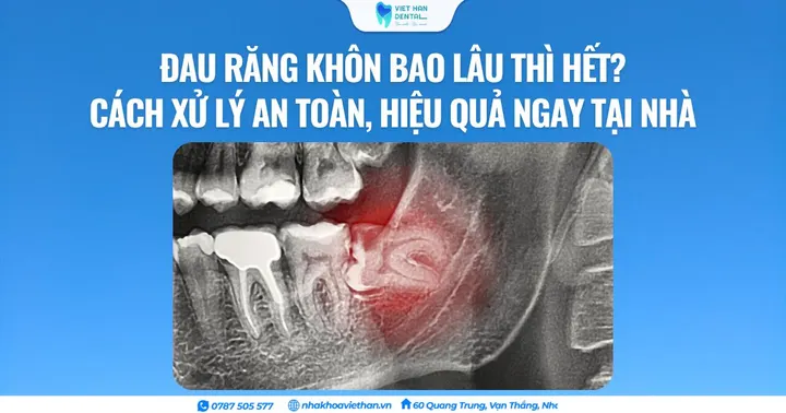 Đau răng khôn bao lâu thì hết? Cách xử lý an toàn, hiệu quả ngay tại nhà