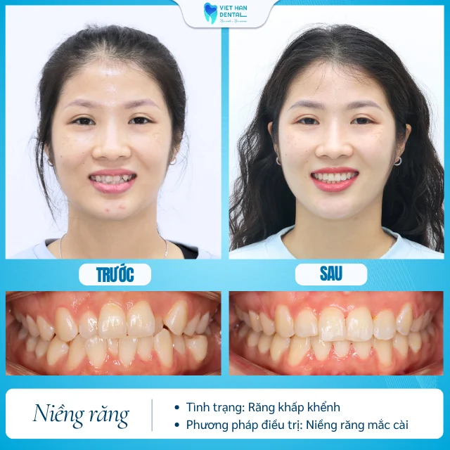 Khách hàng đã niềng răng thành công tại Nha khoa Việt Hàn của Bác sĩ Bùi Thị Giang