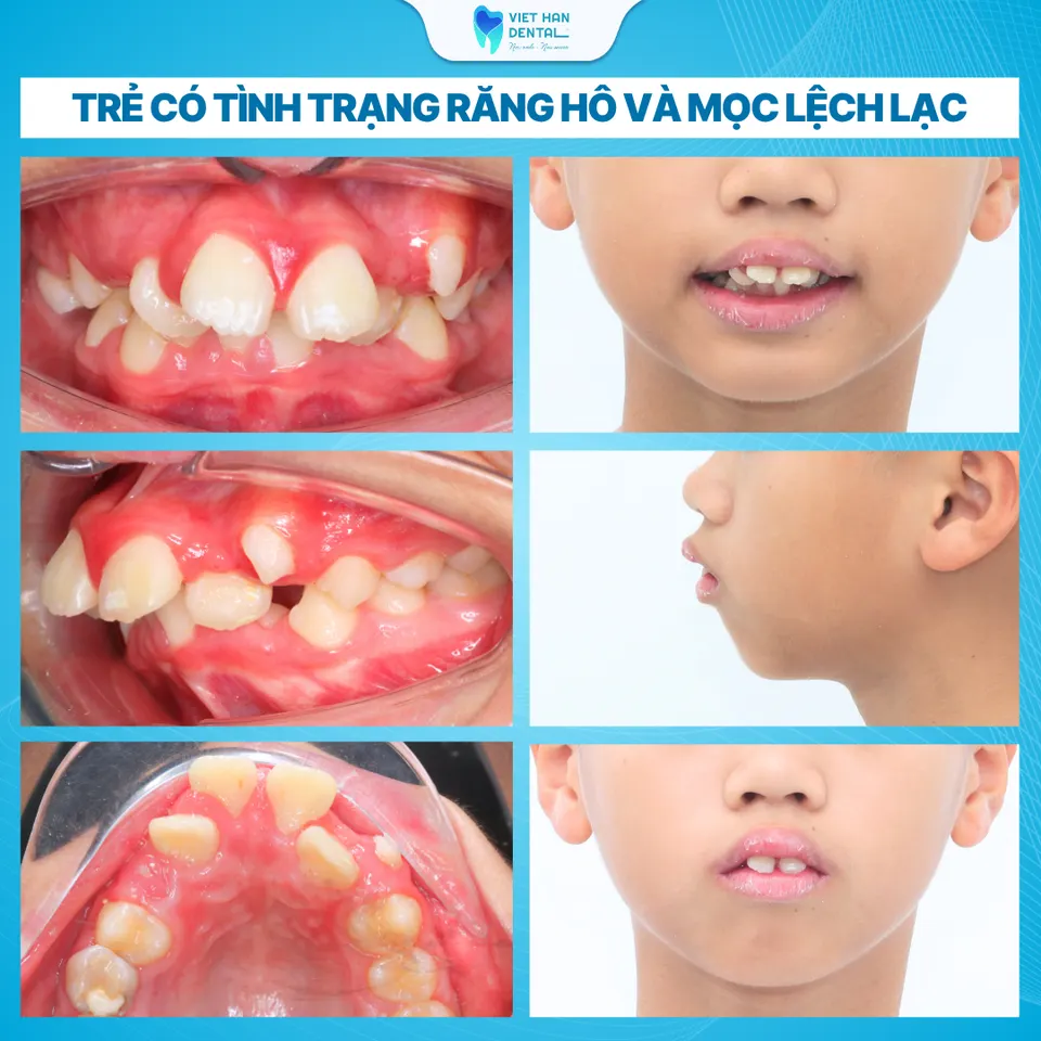 Niềng Răng Tăng Trưởng (2)