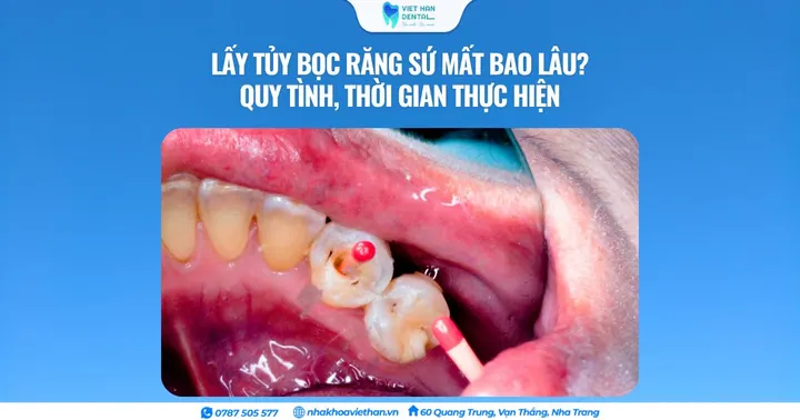 Lấy tủy bọc răng sứ mất bao lâu? Quy tình, thời gian thực hiện