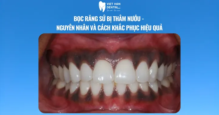 Bọc răng sứ bị thâm nướu – Nguyên nhân và cách khắc phục hiệu quả