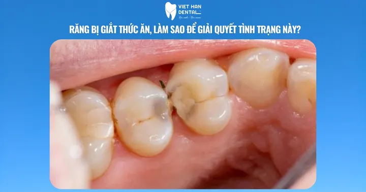 Răng bị giắt thức ăn, làm sao để giải quyết tình trạng này?