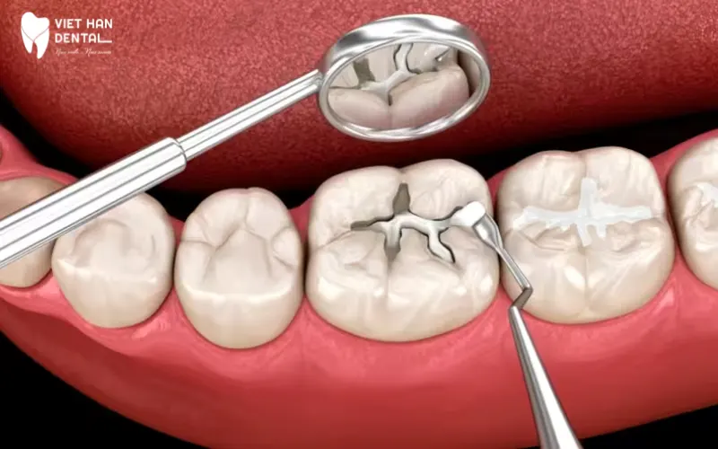 Trám răng là phương pháp chữa sâu răng đơn giản
