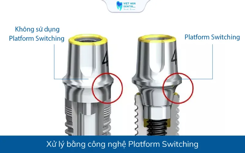 Công nghệ xử lý vùng cổ của trụ implant