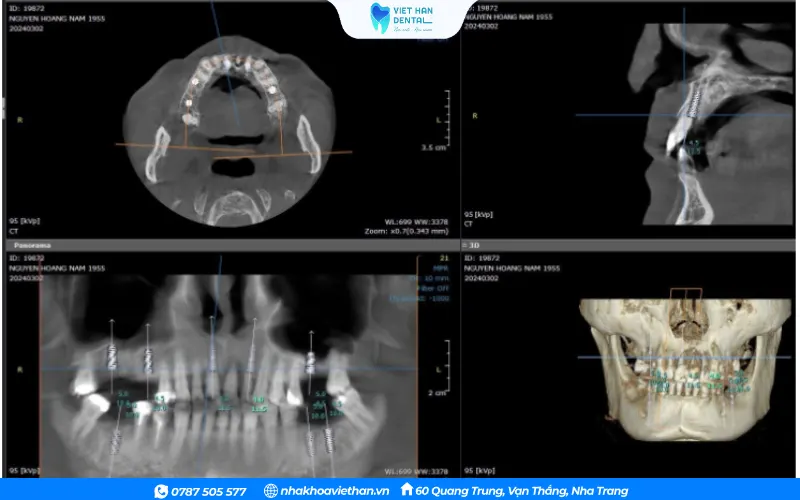 Conbeam CT scan image of Mr. Nam Nguyen after treatment.